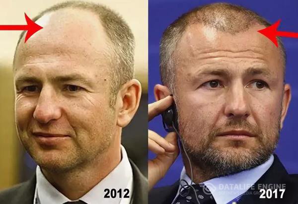 volosyi-andreya-melnichenko-peresadka Андрей Мельниченко волосы